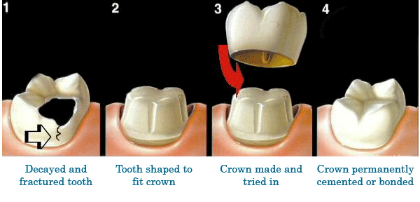 dental crown