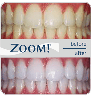 Zoom Teeth Whitening Hilliard OH