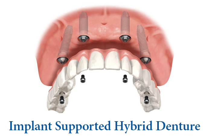 All on 4 hybrid denture