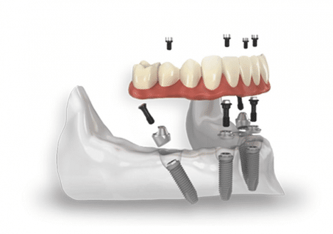 Implant dentures