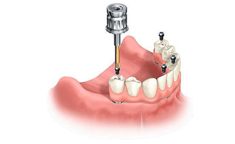 implant dentures