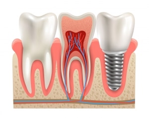 Dental Implants Hilliard