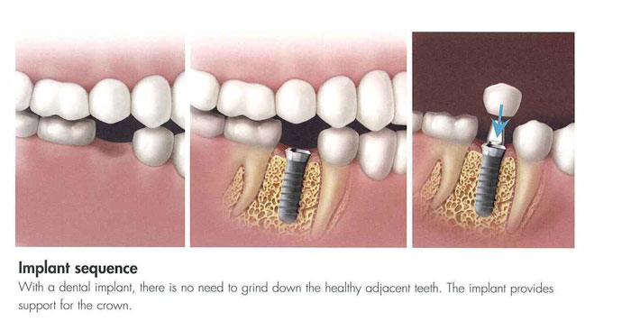 Dental Implants Hilliard OH