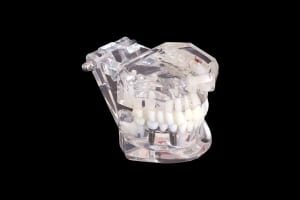 Dental Implants Hilliard Ohio