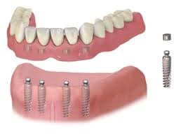 Implant dentures