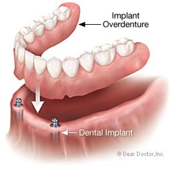 Implant Dentures Hilliard