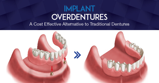 Implant Supported Denture Hilliard OH