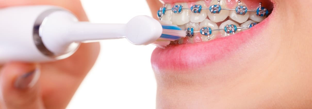 Woman brushing teeth with braces using brush