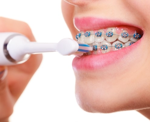 Woman brushing teeth with braces using brush