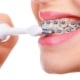 Woman brushing teeth with braces using brush