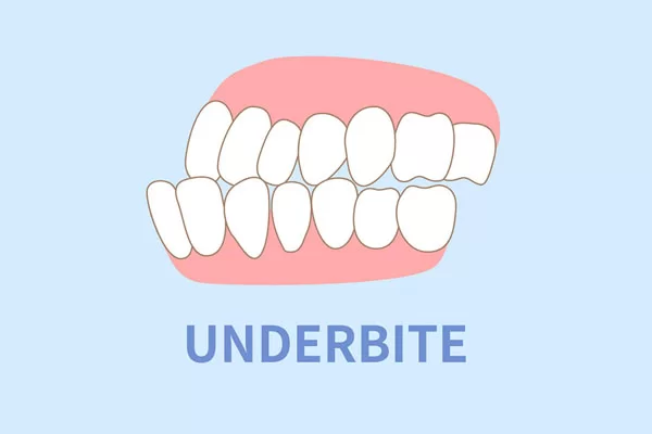 underbite