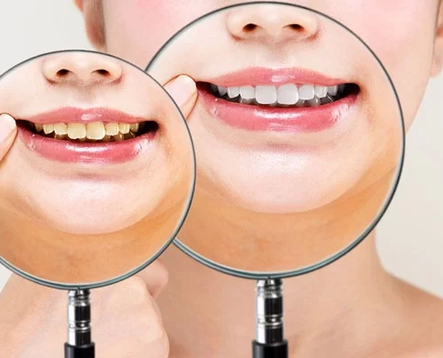 before and after teeth whitening