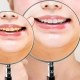 before and after teeth whitening