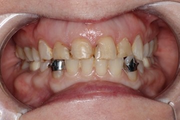 before dental crown treatment
