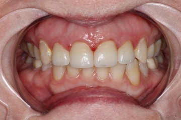 after dental crown treatment