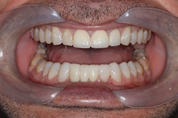 After image
