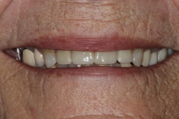 After image
