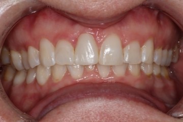 After image