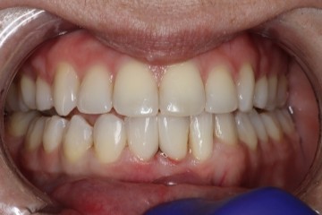 After image