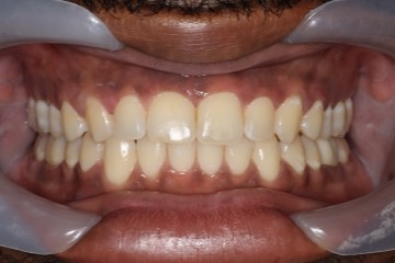 After image