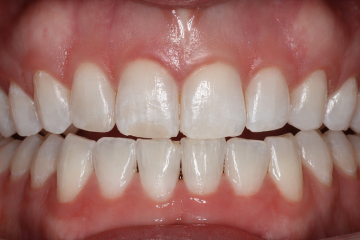 Patient's smile after Invisalign treatment at Fishinger Dental in Hilliard, OH.