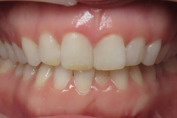 Before Invisalign treatment showing crooked teeth and gapped smile.